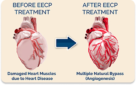 Heart Bit E-ECP